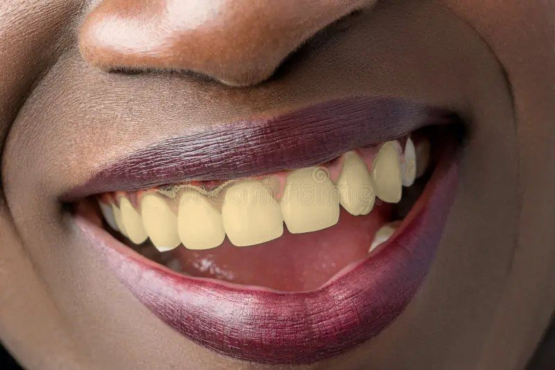 Sourire avec des dents jaunes