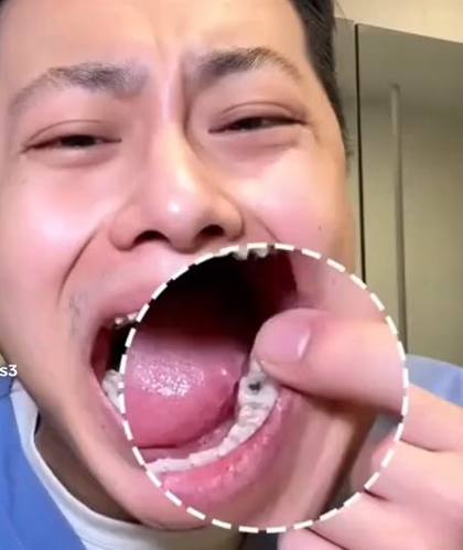 Homme qui montre ses dents trouées par les caries