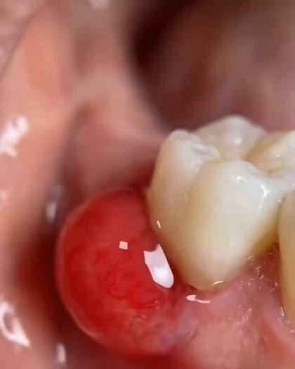 Gencive rouge et gonflée à côté d'une dent