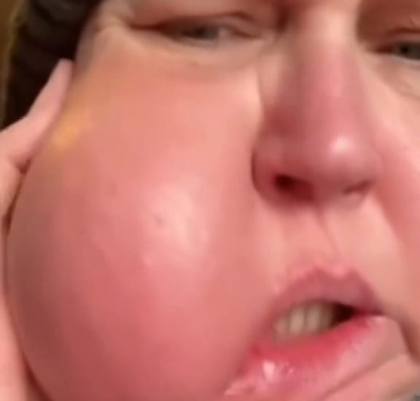 Femme avec la joue gonflée par une douleur dentaire